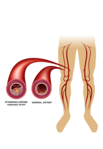 Peripheral Arterial Occlusive Disease - Seattle Vascular