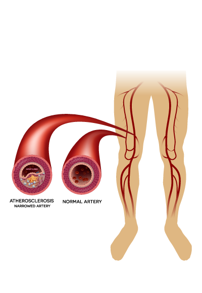 Peripheral Arterial Occlusive Disease graphic.